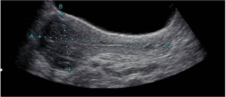 Ultrasound sag uterus